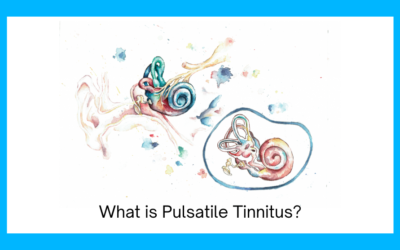 What is Pulsatile Tinnitus?